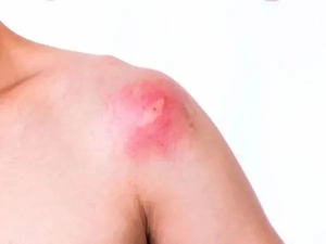 first aid myths