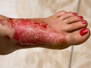 first aid myths